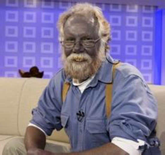 世界上竟然有蓝种人,世界上竟然有蓝种人吗?